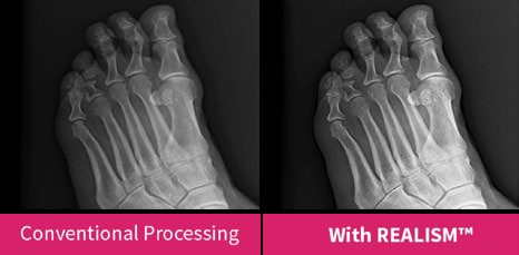 Momentum DR REALISM processing on a weight-bearing foot radiograph