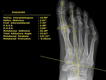 DPM measurement overlay on a weight-bearing foot radiograph — hallux, IMA, PASA, DASA, metatarsal parabola